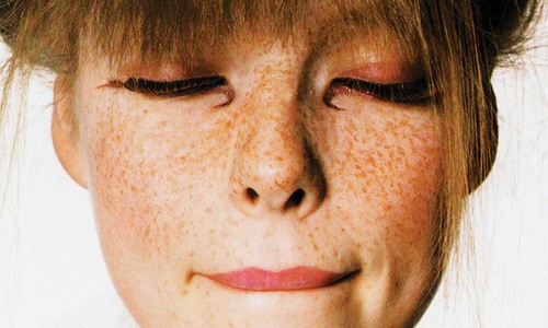 Freckles -Age spots - Discoloration