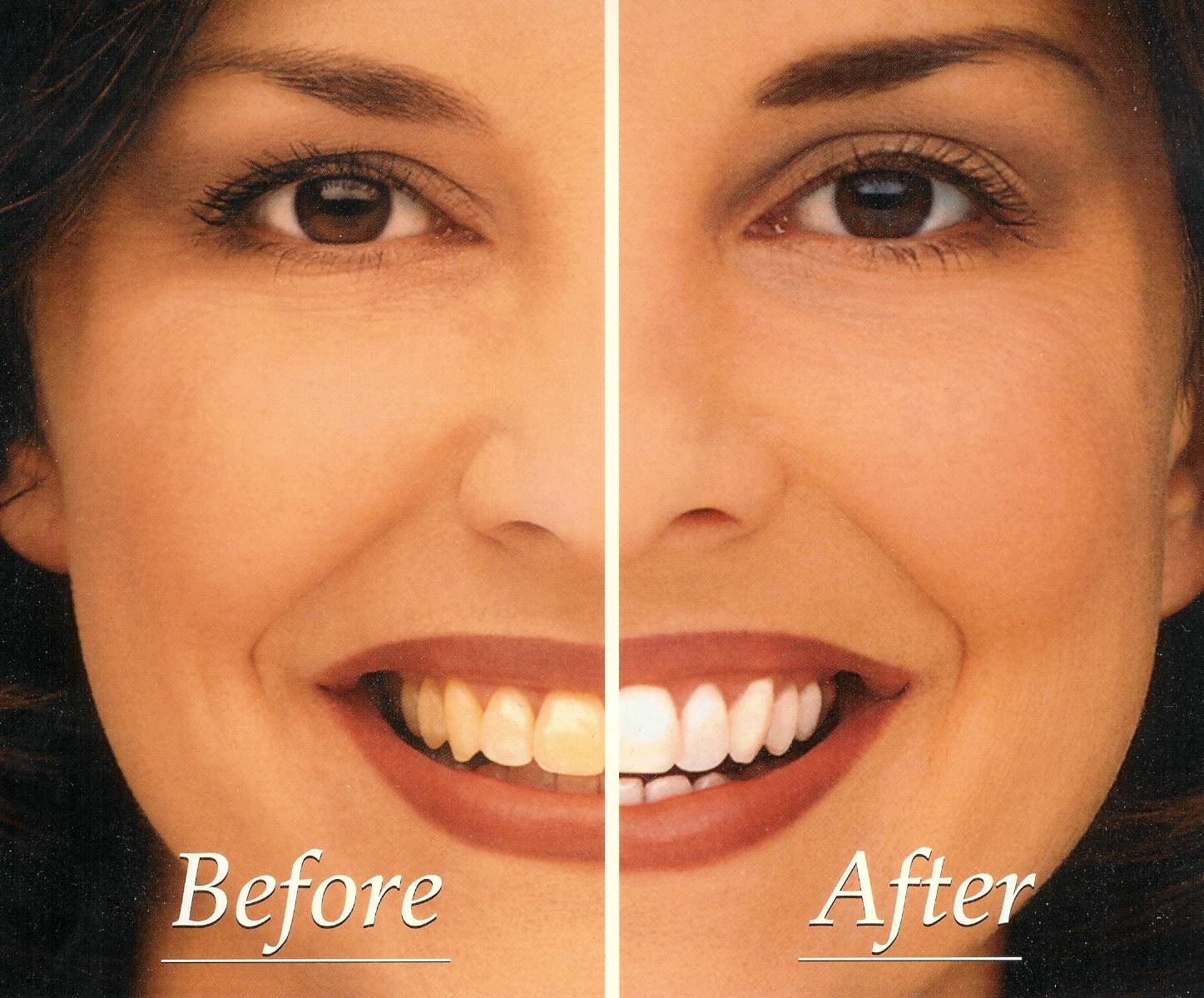 Whitening Systems