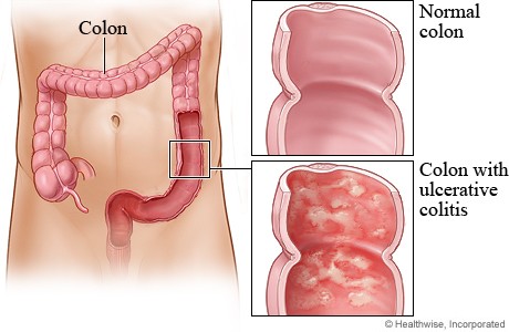 Ελκώδης Κολίτιδα-Νόσος του Crohn